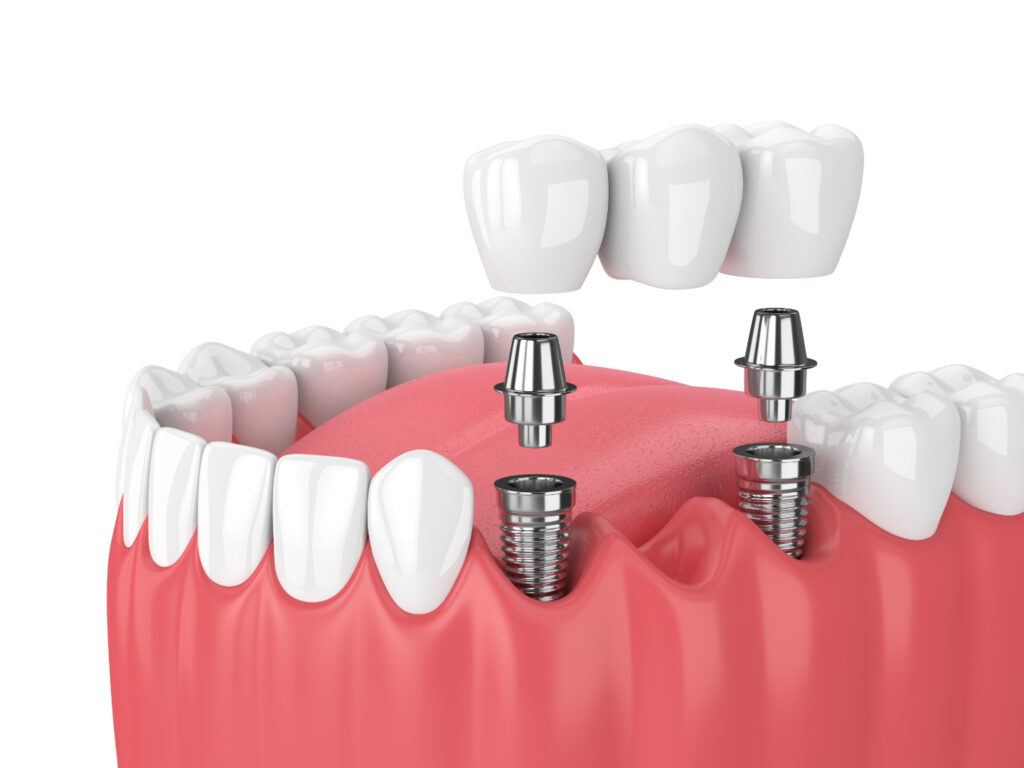 Dental implants Turkey