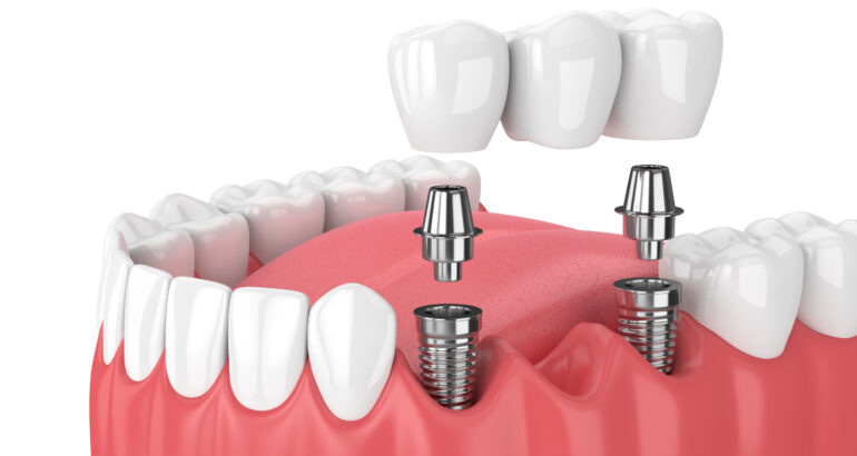Dental implants Turkey