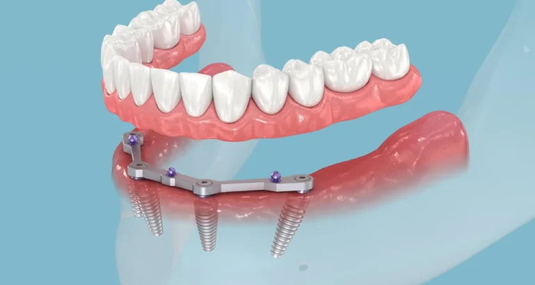 Tooth implant