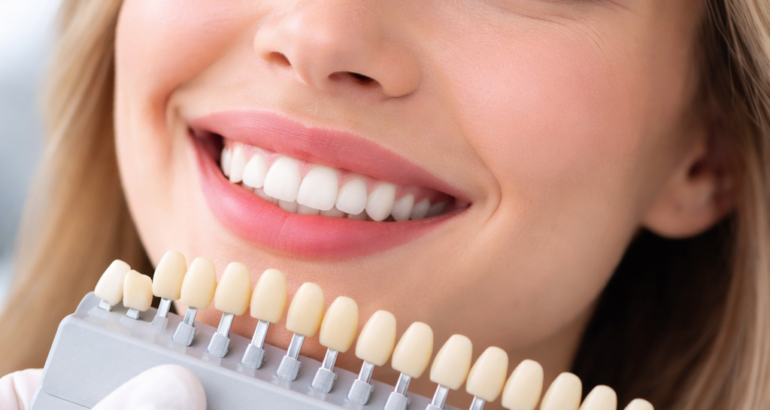 Veneers Konyaaltı