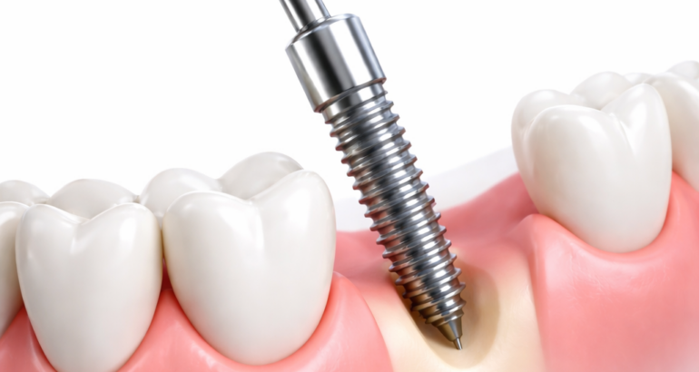 German dental implant Konyaaltı
