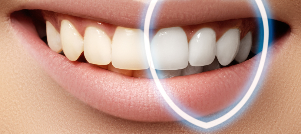 Hollywood Smile Türkei Preis