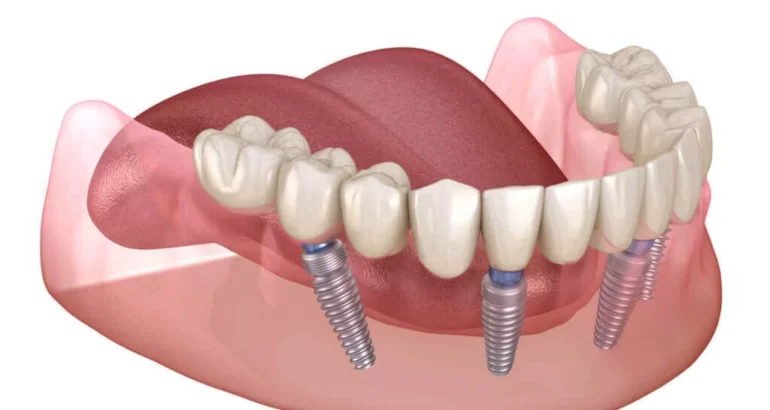 All on Four Dental Implants