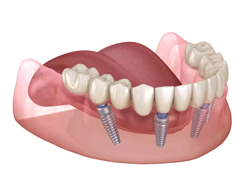 All on Four Dental Implants