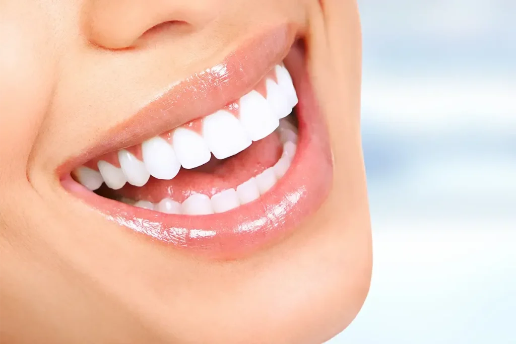 Dental Veneers Emax