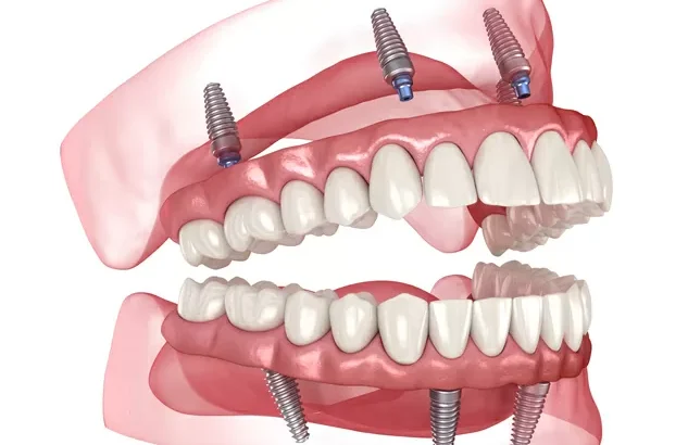 Teeth implants turkey price